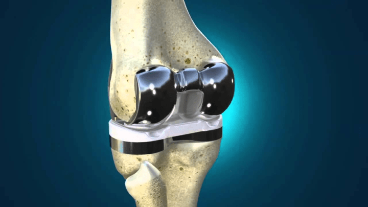 WHAT CAUSED THE EXACTECH KNEE IMPLANT TO BE&nbsp;RECALLED?